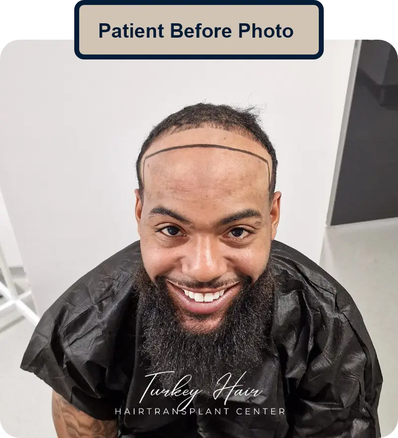 Home Hair Restoration Excellence You Can Trust