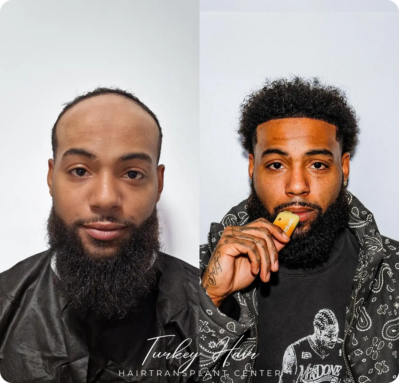 Afro Hair Transplant