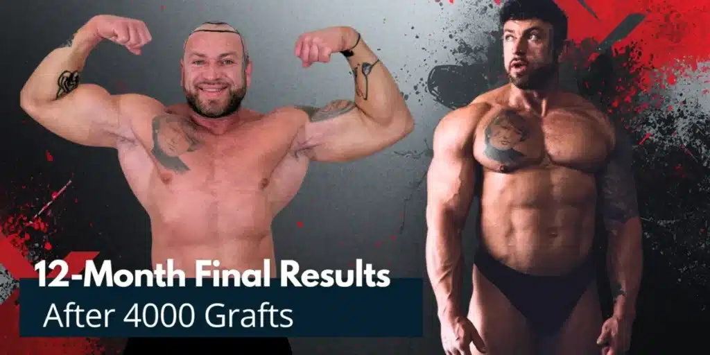 12-Month-Final-Results-After-4000-Grafts-1200X600 4000 Grafts Hair Transplant Turkey – Cost And Procedure Hair Restoration Excellence You Can Trust