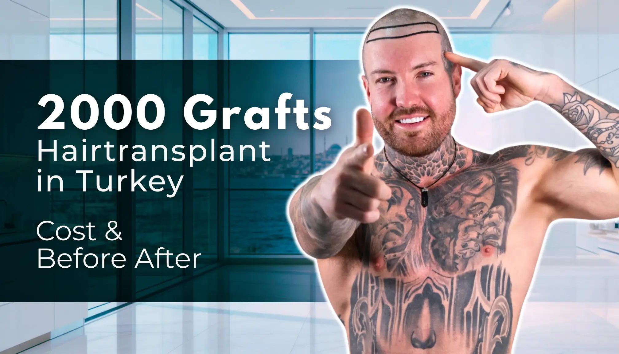 2000 Grafts Hair Transplant In Turkey – Cost &Amp;Amp; Before After 1 2000 Grafts Hair Transplant In Turkey – Cost &Amp;Amp; Before After Hair Restoration Excellence You Can Trust