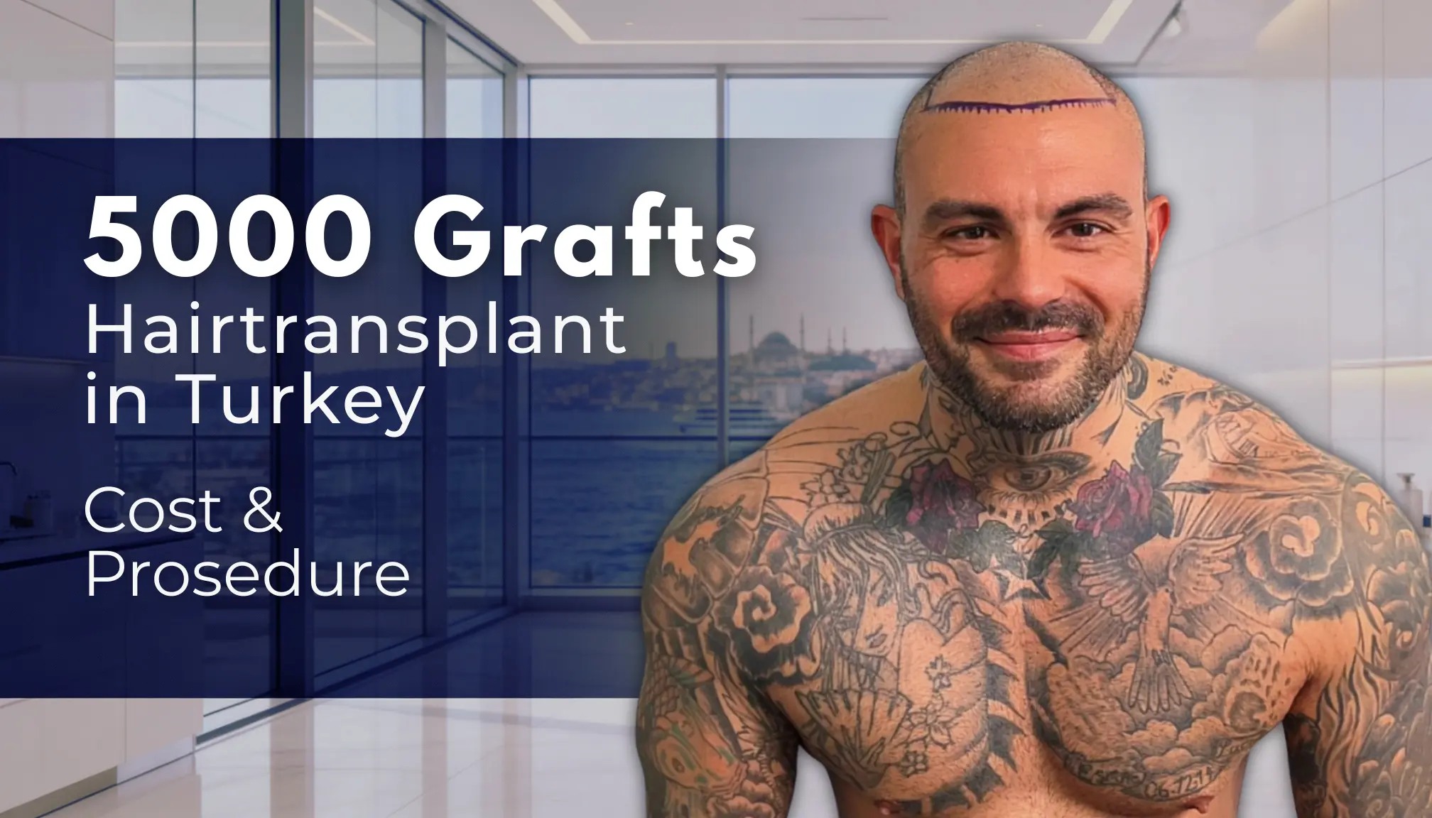 5000 Grafts Hair Transplant Turkey – Cost – Before and After