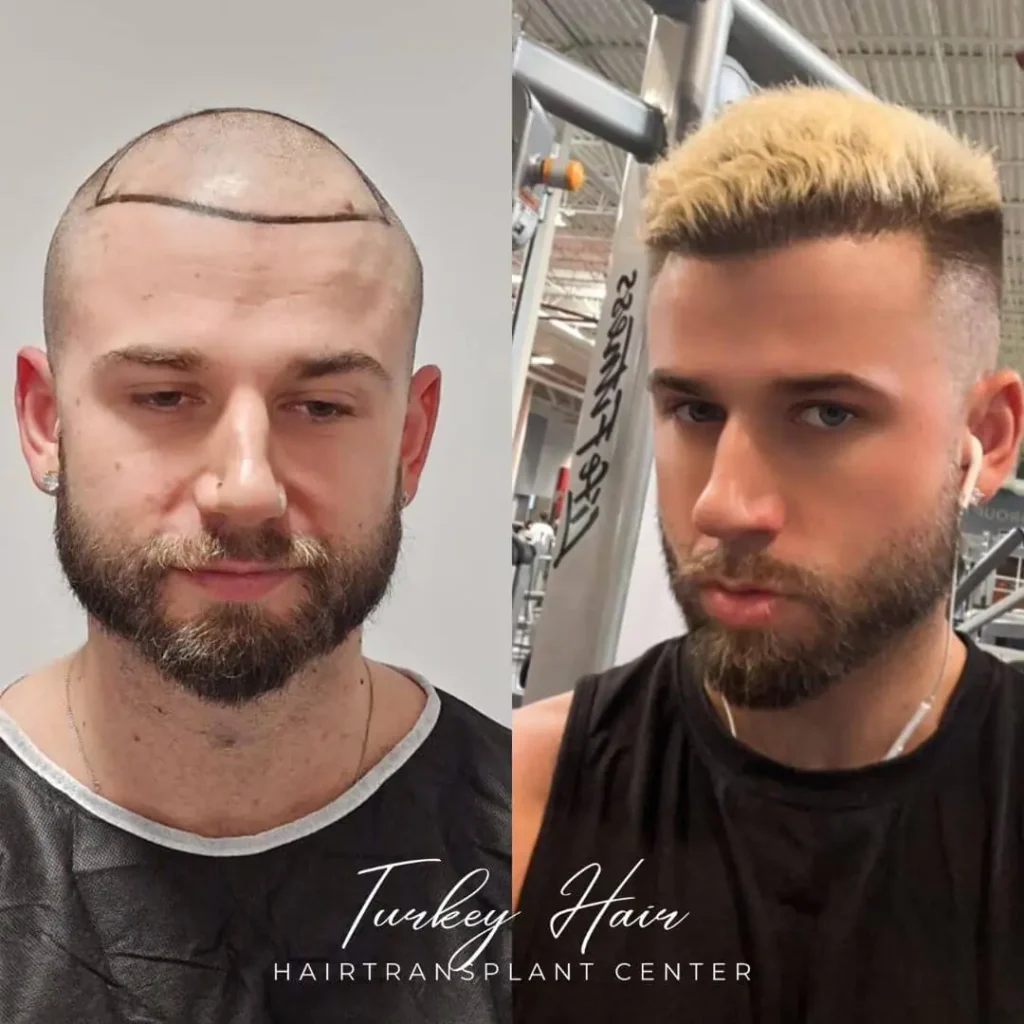 5000-Grafts-Hair-Transplant-Before-After-2.Jpg 5000 Grafts Hair Transplant Turkey – Cost – Before And After Hair Restoration Excellence You Can Trust