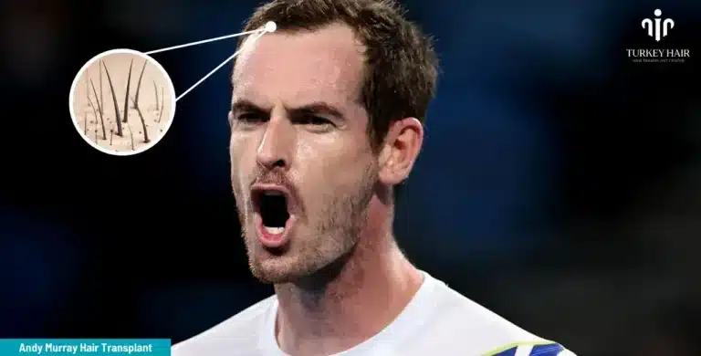 Andy-Murray-Hair-Transplant-2-2-1-768X390 Britain’s Number 1 Tennis Player Andy Murray’s Hair Transplant Hair Restoration Excellence You Can Trust