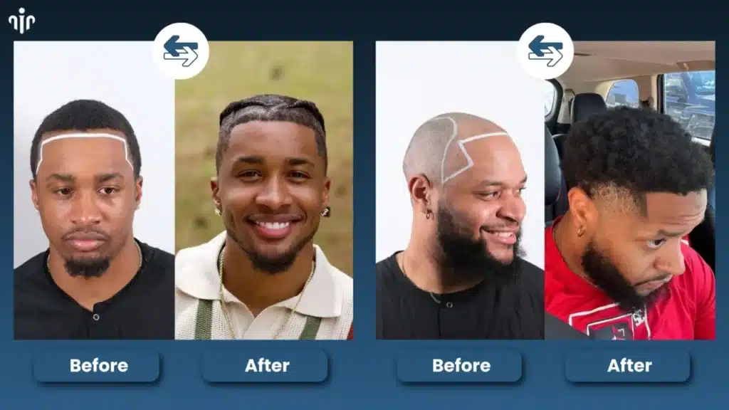 Top Men’s Hairstyles That Suit Receding Or Balding Hairlines Hair Restoration Excellence You Can Trust
