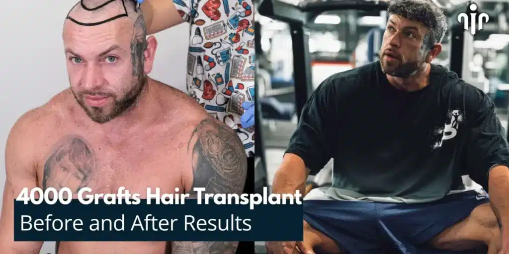 Before-And-After-Results-Of-4000-Grafts-Hair-Transplant-1200X600 4000 Grafts Hair Transplant Turkey – Cost And Procedure Hair Restoration Excellence You Can Trust