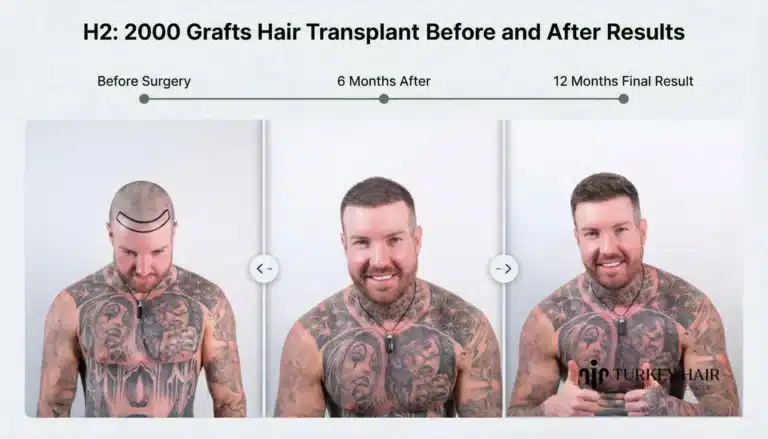 Before-And-After-Result-768X439 2000 Grafts Hair Transplant In Turkey – Cost &Amp; Before After Hair Restoration Excellence You Can Trust