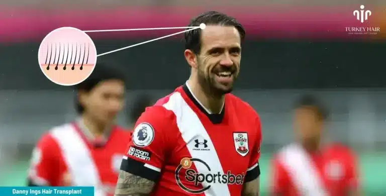 Danny-Ings-Hair-Transplant-1-1-768X390 Let’s Discover Succesfull Striker Danny Ings’ Hair Transplant 2026 Hair Restoration Excellence You Can Trust
