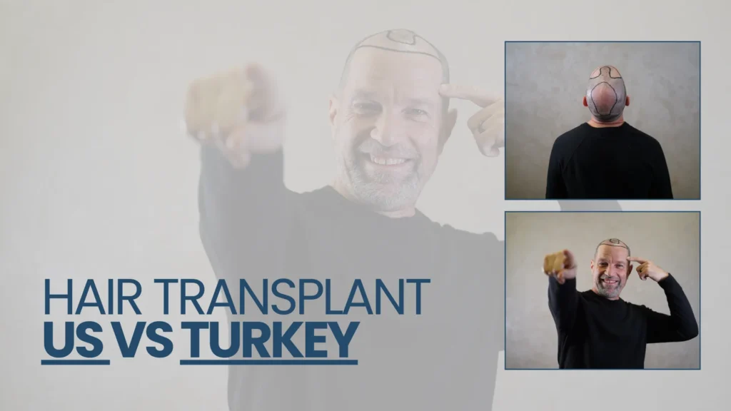 Hair Transplant Us Vs Turkey – Cost, Quality And Key Facts Hair Restoration Excellence You Can Trust