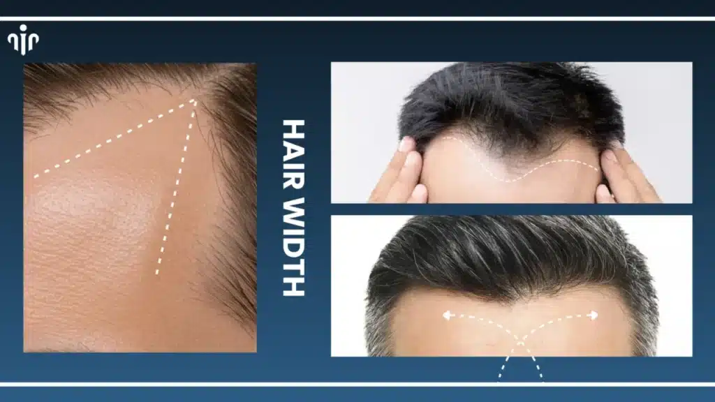 Top Men’s Hairstyles That Suit Receding Or Balding Hairlines Hair Restoration Excellence You Can Trust
