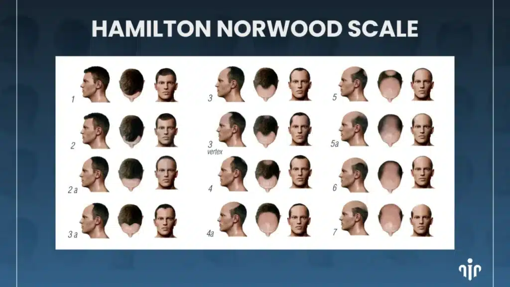 Top Men’s Hairstyles That Suit Receding Or Balding Hairlines Hair Restoration Excellence You Can Trust