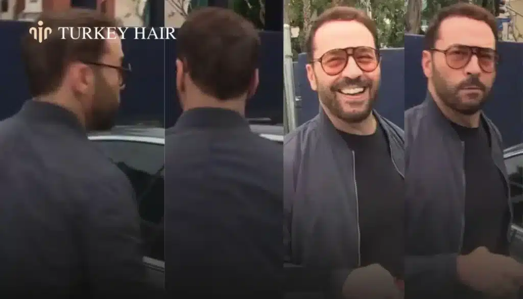 Jeremy-Piven-Hair-Transplant-–-Before-and-After-3-1344x768