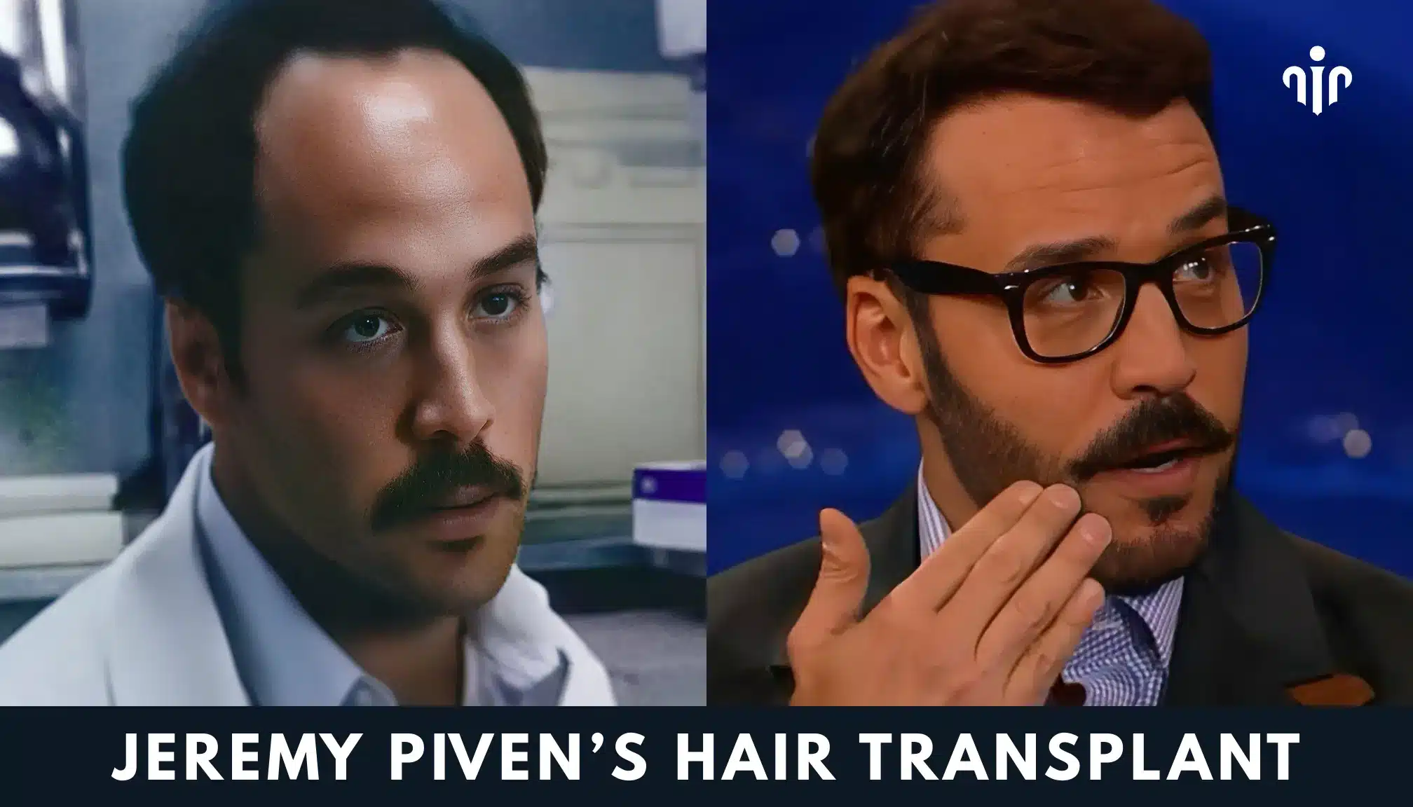 Jeremy Piven Hair Transplant – Before and After