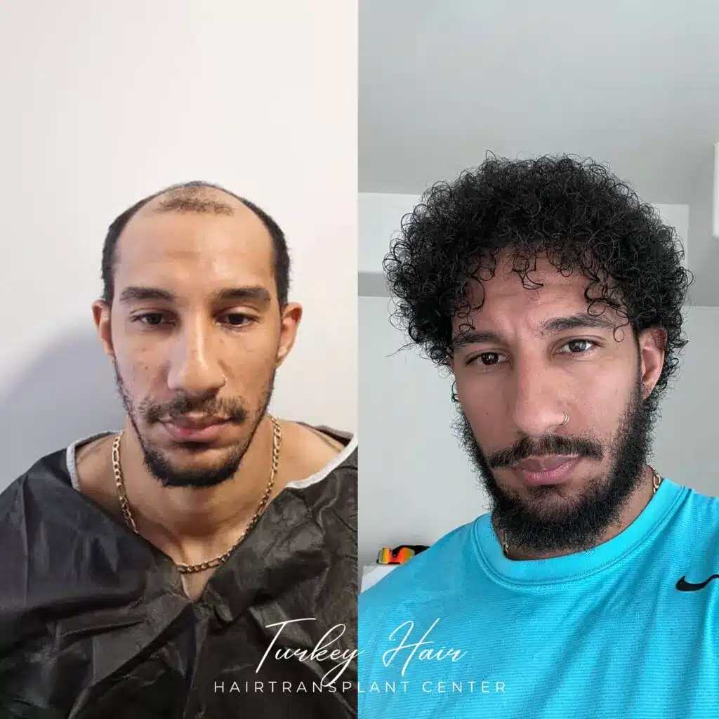 Afro Hair Transplant Dense And Curly Result