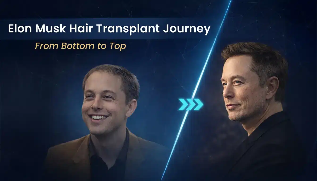 Elon Musk Hair Transplant: Fut &Amp;Amp; Fue Before/After Analysis 1 Elon Musk Hair Transplant: Fut &Amp;Amp; Fue Before/After Analysis Hair Restoration Excellence You Can Trust