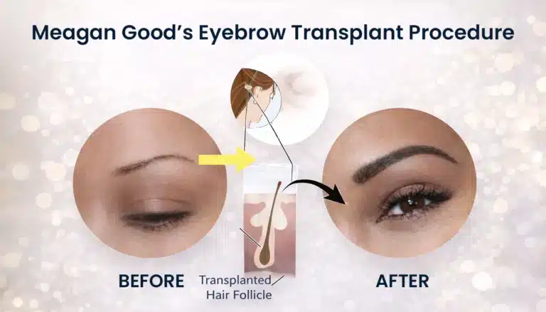Meagan-Good-Eyebrow-Transplant-Procedure-768X439 Meagan Good Eyebrow Transplant Before And After Hair Restoration Excellence You Can Trust