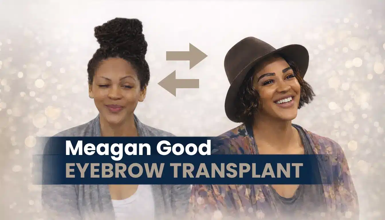 Meagan Good Eyebrow Transplant Before And After 1 Meagan Good Eyebrow Transplant Before And After Hair Restoration Excellence You Can Trust