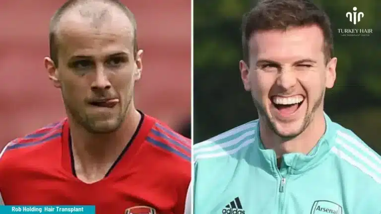 Rob Holding Hair Transplant Hair Restoration Excellence You Can Trust