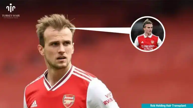 Rob Holding Hair Transplant Hair Restoration Excellence You Can Trust