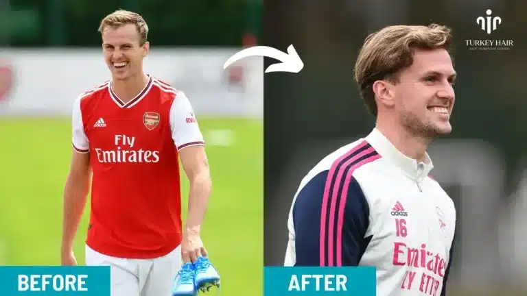 Rob Holding Hair Transplant Hair Restoration Excellence You Can Trust