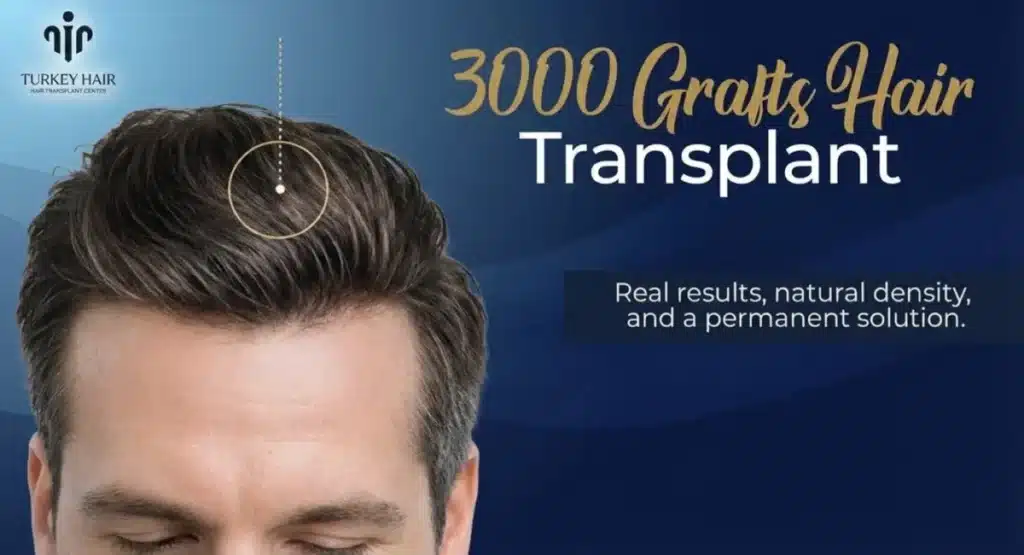 Surgeon-And-Team-1200X650 3000 Grafts Hair Transplant Turkey – Cost And Procedure Hair Restoration Excellence You Can Trust