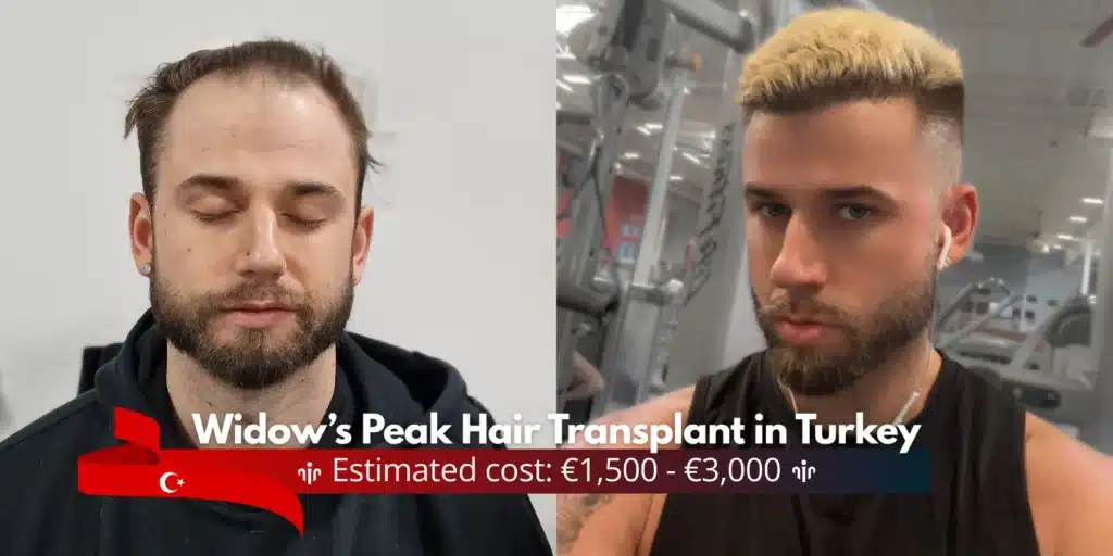 Widows-Peak-Hair-Transplant-Cost-In-Turkey Widow’s Peak Hair Transplant In Turkey – Cost- Before And After Hair Restoration Excellence You Can Trust