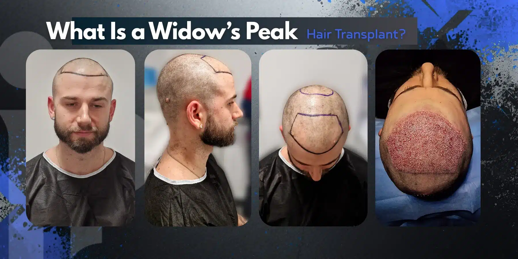 Widow’s Peak Hair Transplant in Turkey – Cost- Before and After