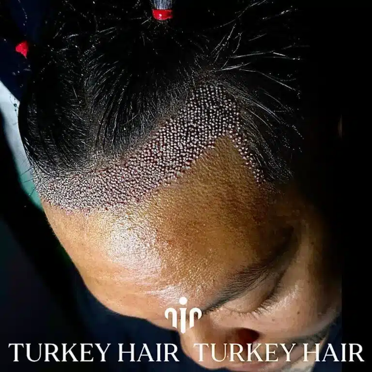 After-1000-Grafts-Hair-Transplant-768X768.Jpg 1000 Grafts Hair Transplant In Turkey – Cost – Before And After Hair Restoration Excellence You Can Trust