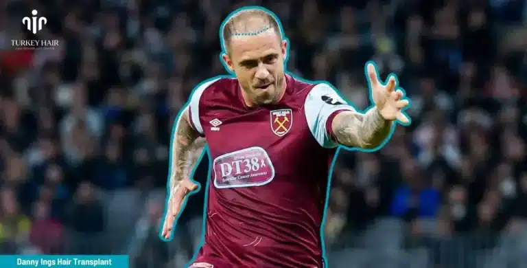 Danny-Ings-Hair-Transplant-2-1-768X390 Let’s Discover Succesfull Striker Danny Ings’ Hair Transplant 2026 Hair Restoration Excellence You Can Trust