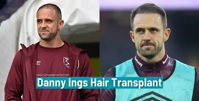Danny-Ings-Hair-Transplant-4-1-768X390 Let’s Discover Succesfull Striker Danny Ings’ Hair Transplant 2026 Hair Restoration Excellence You Can Trust