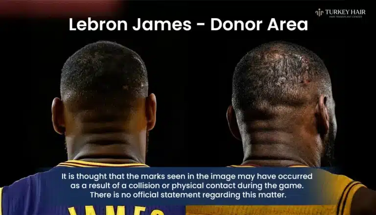 Lebron-James-Donor-Area-Back-Of-Head-Analysis-768X439 Lebron James Donor Area