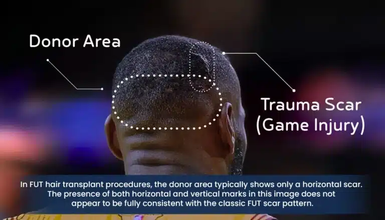 Lebron-James-Donor-Area-Trauma-Scar-Fue-Fut-Analysis-768X439 Lebron James Donor Area