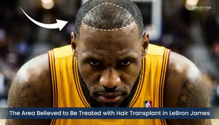 Lebron-James-Frontal-Hairline-Treated-Area-Analysis-768X439 Lebron James Hairline Restoration