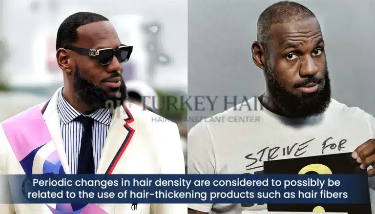 Lebron-James-Hair-Density-Changes-Hair-Fiber-Speculation-768X439 Lebron James Hair Density