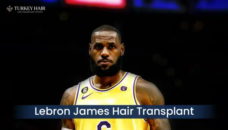 Lebron-James-Hair-Transplant-768X439 Lebron James Hair Transplant