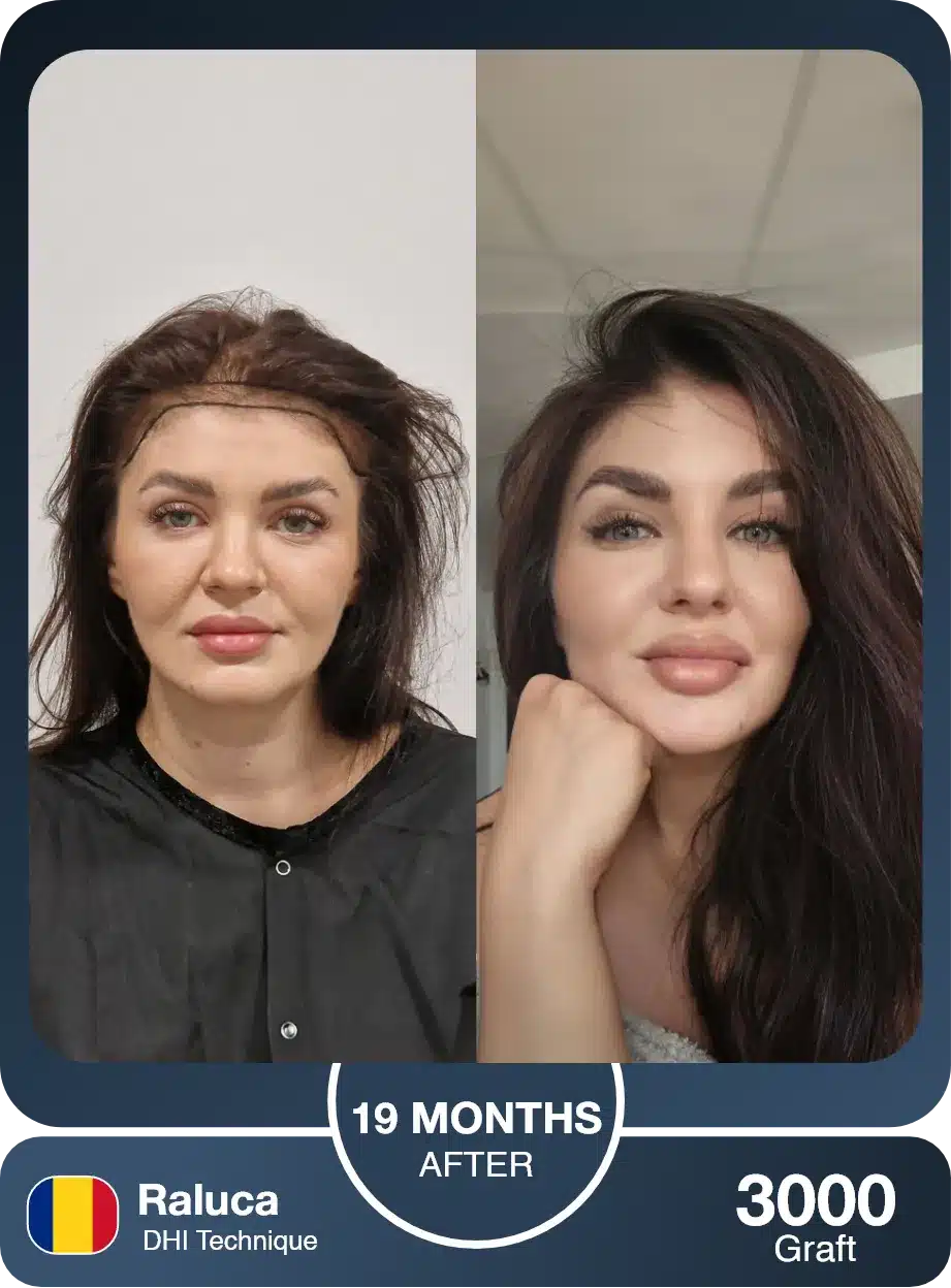 Female Hair Transplant Before And After Result