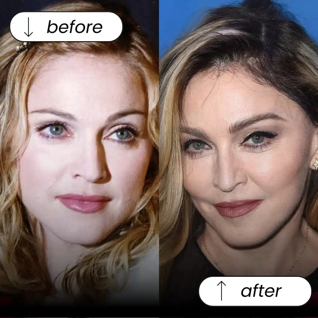 Eyebrow Transplant In Turkey – Cost, Before &Amp; After Hair Restoration Excellence You Can Trust