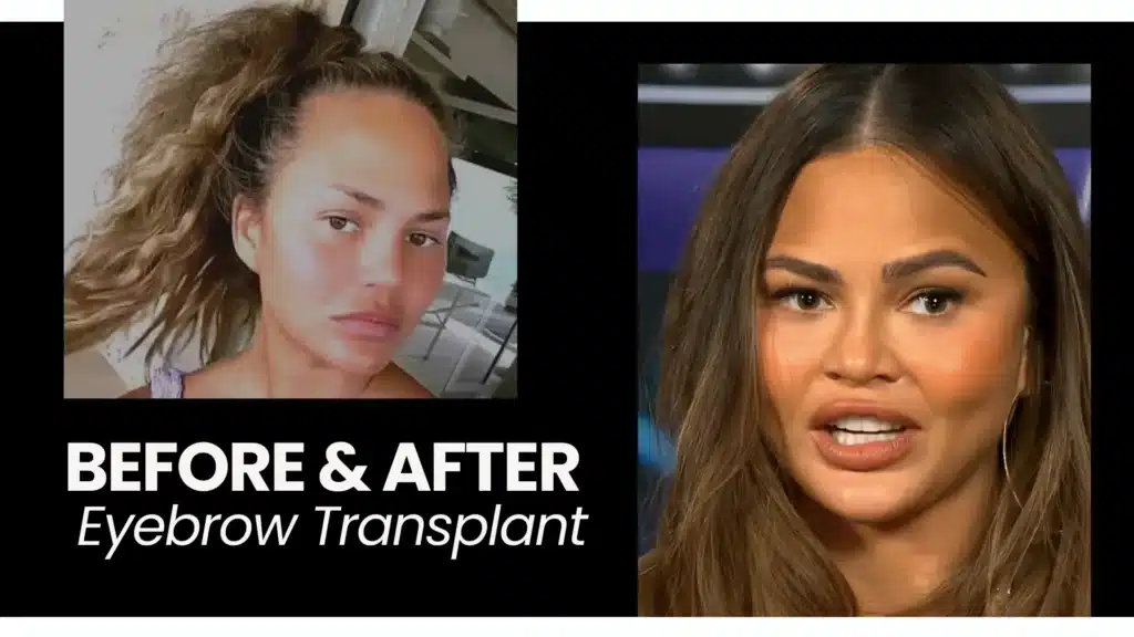 Eyebrow Transplant Before And After