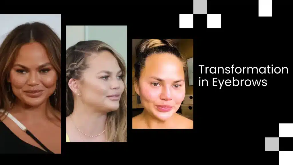 Eyebrow Transplant Transformation Before And After