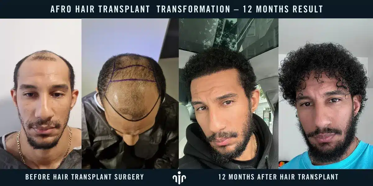 Final Results Are Typically Visible After 12 Months, With Full Hair Growth And Natural Density Achieved.