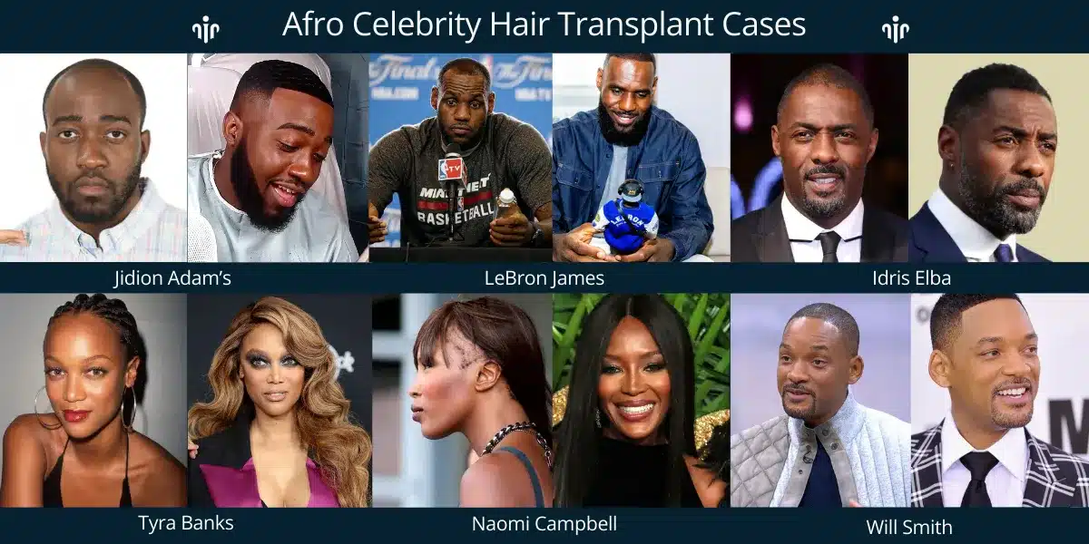Afro Celebrity Hair Transplant Results Highlight Natural Hairline Design And Successful Restoration For Curly Hair Types.