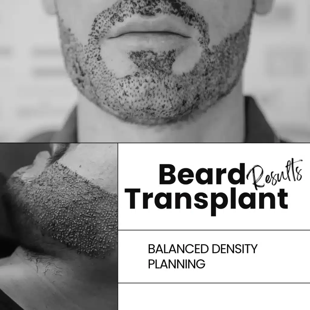 Beard Transplant Results Showing Natural Beard Density And Well-Defined Facial Hair Design.