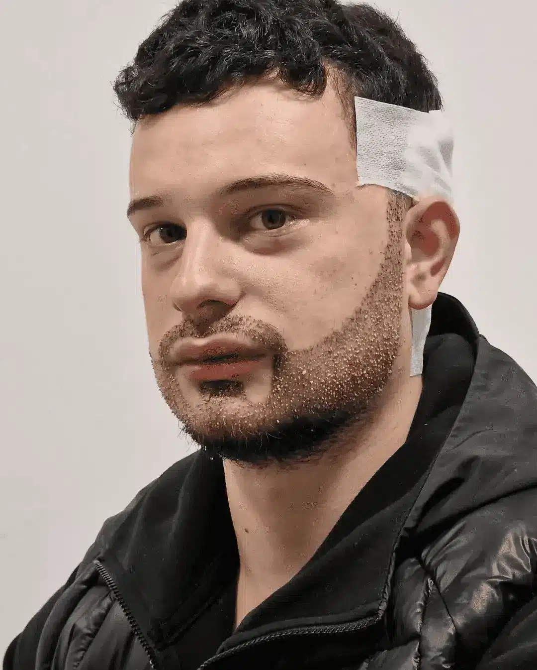 Beard-Mustache Transplant