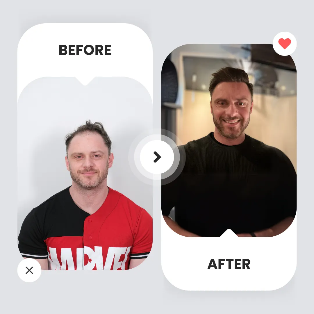 Dhi Hair Transplant 11 Dhi Hair Transplant Before After
