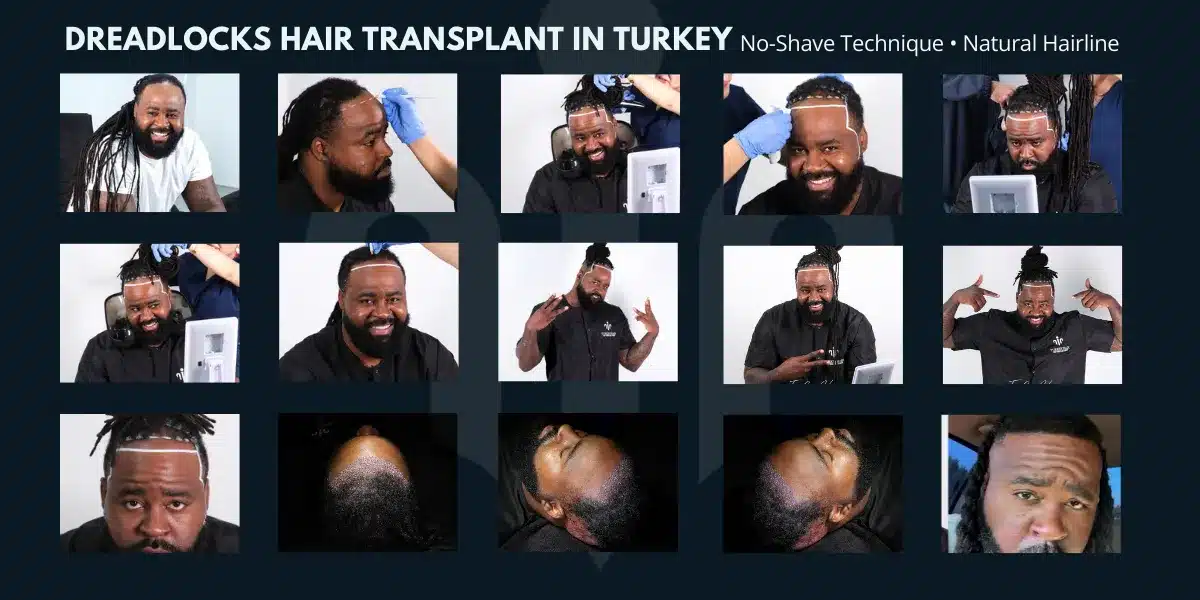 No Shave Hair Transplant Is A Technique That Allows Hair Transplantation Without Shaving The Donor Or Recipient Area.