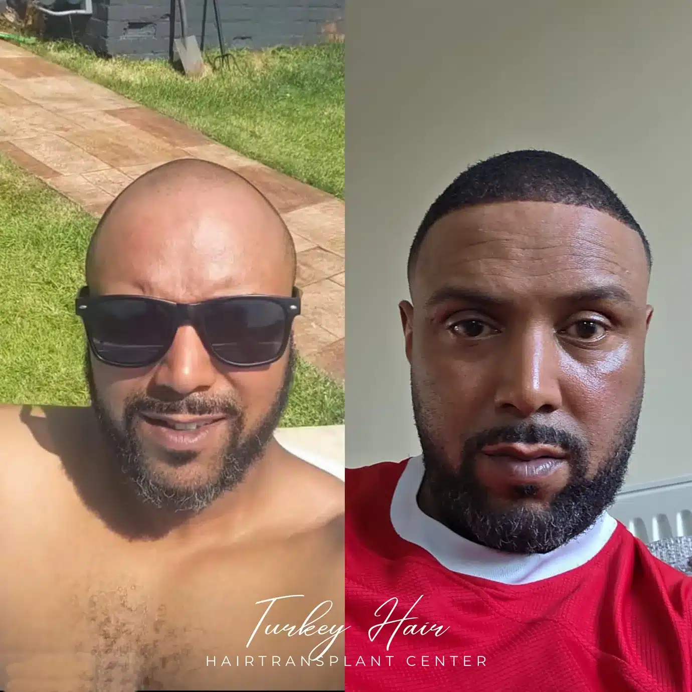 Hair Transplants Patient