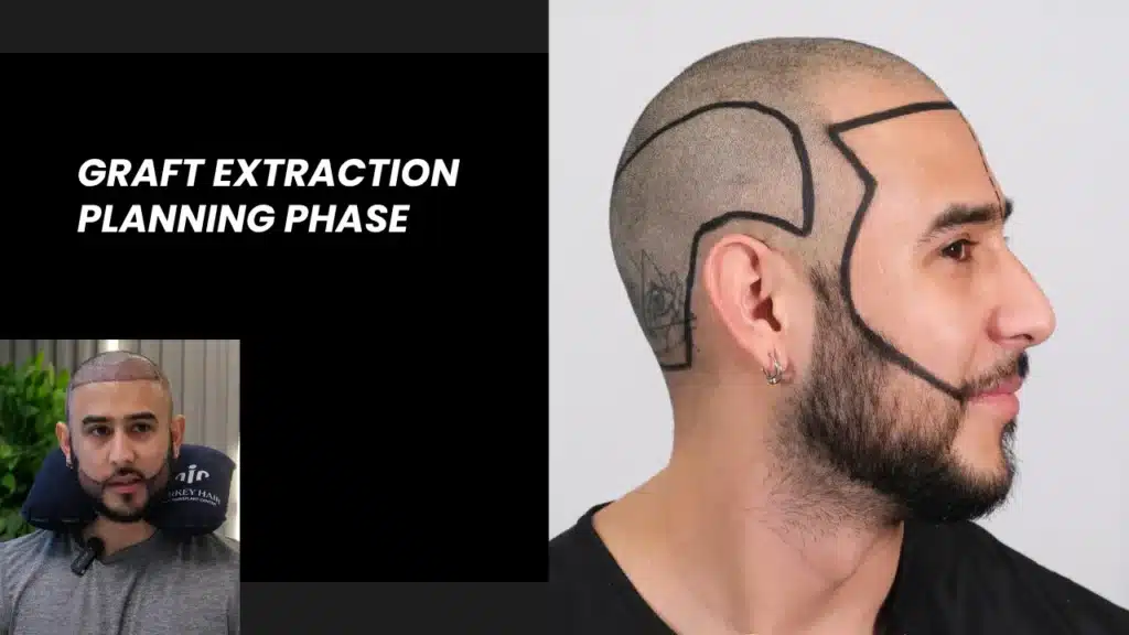 Graft Planning Course Teaches How To Calculate Graft Numbers And Design Natural Hair Transplant Results.