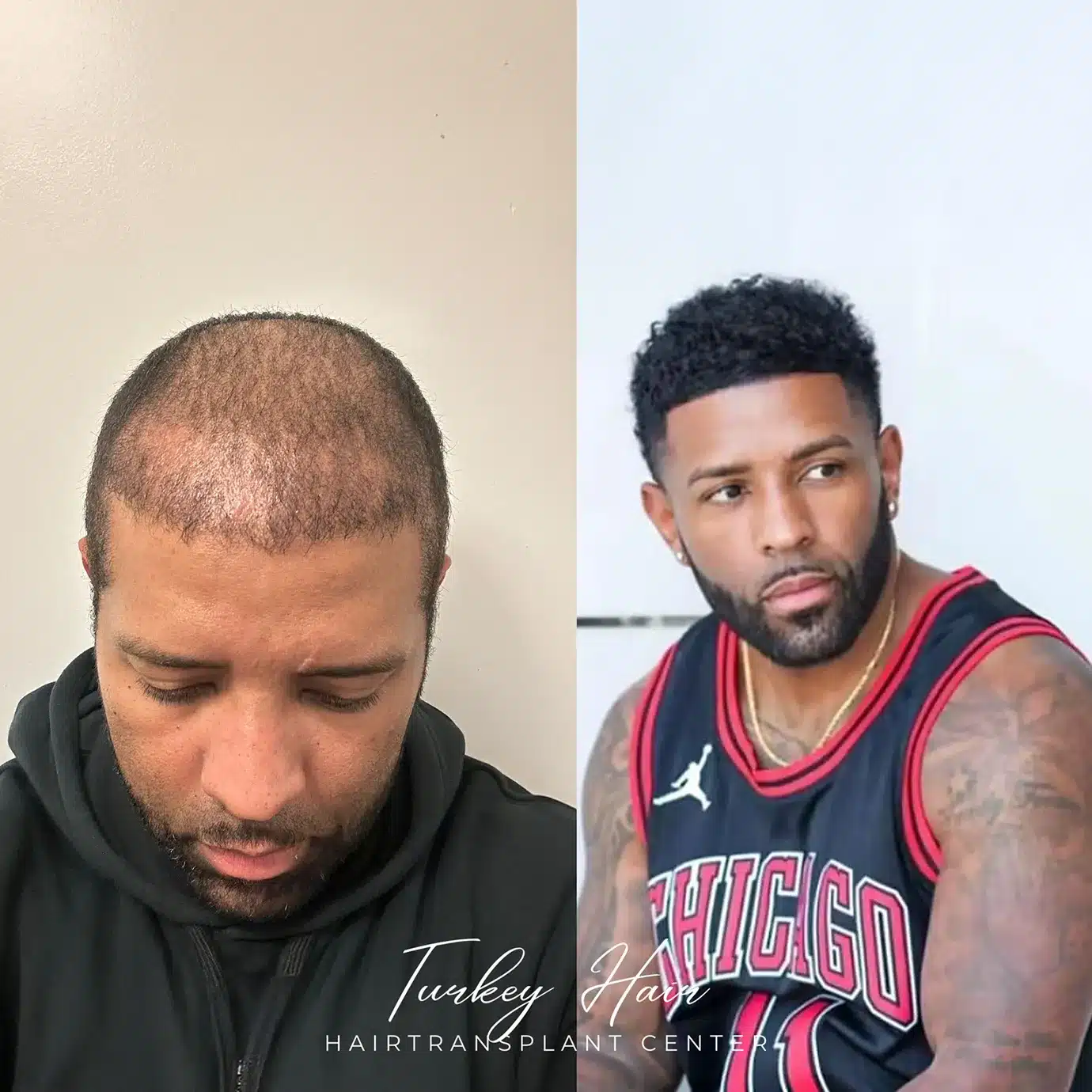 Hair Transplants Patient