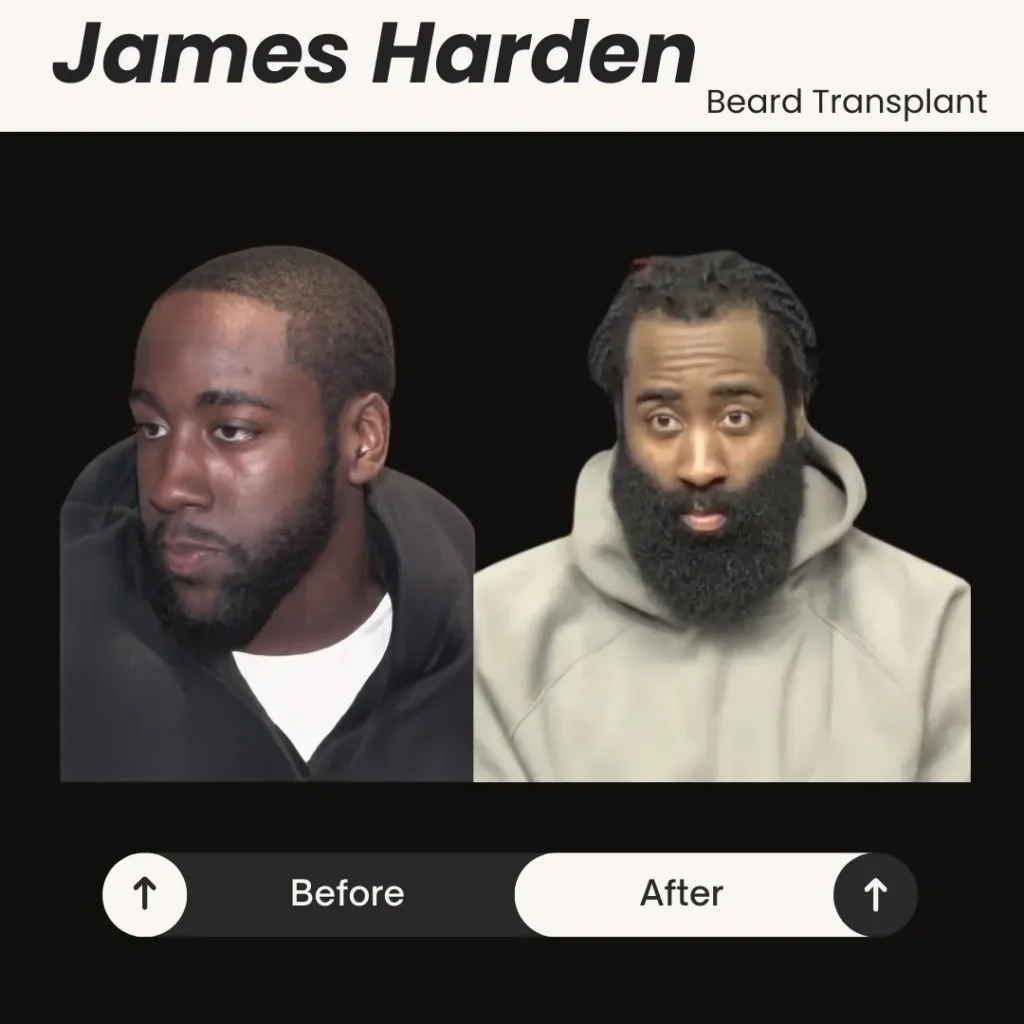 James Harden Before And After Photos Showing Changes In Hairline And Overall Hair Density.