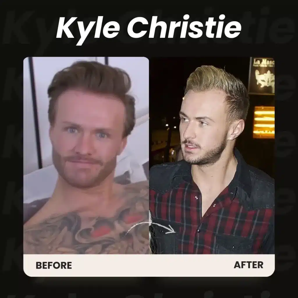 Kyle Christie Beard Transplant Before And After Results Showing Natural Beard Density And Defined Facial Hair Design.