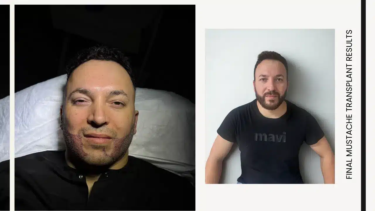 Mustache Transplant Before &Amp; And After